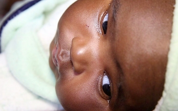 Nearly 19 million newborns at risk of brain damage every year due to iodine deficiency